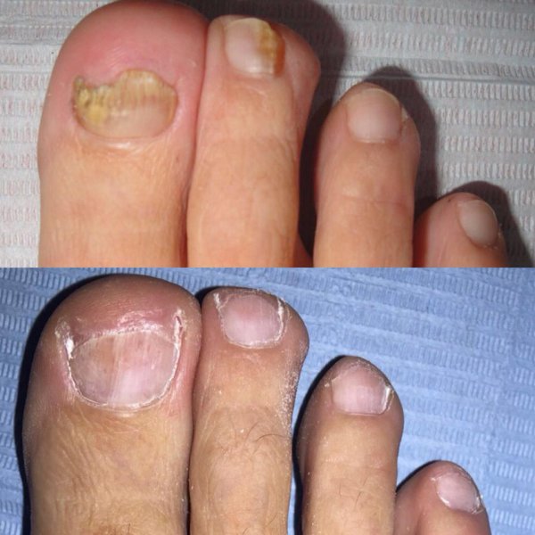 Spray eliminador de hongos PRONAIL FORTE™